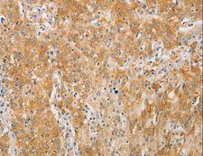 PDE4D Antibody - Immunohistochemistry of paraffin-embedded Human gastric cancer using PDE4D Polyclonal Antibody at dilution of 1:20.
