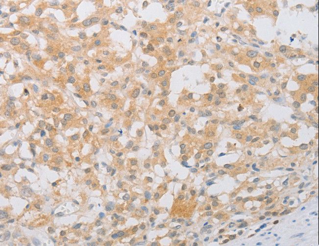 PDE4D Antibody - Immunohistochemistry of paraffin-embedded Human thyroid cancer using PDE4D Polyclonal Antibody at dilution of 1:20.