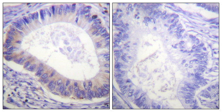 PDE4D Antibody - Immunohistochemistry analysis of paraffin-embedded human colon carcinoma, using PDE4D (Phospho-Ser190/53) Antibody. The picture on the right is blocked with the phospho peptide.