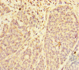 PDE6A / PDE6 Alpha Antibody - Immunohistochemistry of paraffin-embedded human ovarian cancer at dilution of 1:100