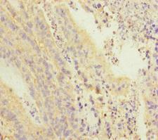 PDE6A / PDE6 Alpha Antibody - Immunohistochemistry of paraffin-embedded human colon cancer at dilution of 1:100