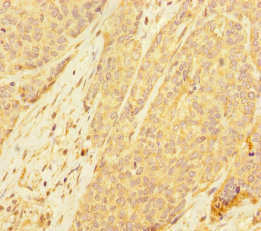 PDE6A / PDE6 Alpha Antibody - Immunohistochemistry of paraffin-embedded human ovarian cancer at dilution of 1:100