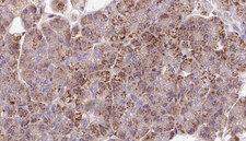 PDE6A / PDE6 Alpha Antibody - 1:100 staining human pancreas carcinoma tissue by IHC-P. The sample was formaldehyde fixed and a heat mediated antigen retrieval step in citrate buffer was performed. The sample was then blocked and incubated with the antibody for 1.5 hours at 22°C. An HRP conjugated goat anti-rabbit antibody was used as the secondary.