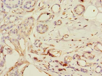 PDE6D / PDE6 Delta Antibody - Immunohistochemistry of paraffin-embedded human breast cancer using antibody at dilution of 1:100.