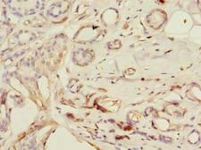 PDE6D / PDE6 Delta Antibody - Immunohistochemistry of paraffin-embedded human breast cancer using antibody at dilution of 1:100.