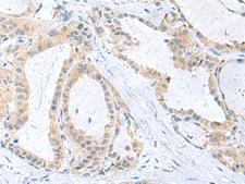 PDE6D / PDE6 Delta Antibody - Immunohistochemistry of paraffin-embedded Human thyroid cancer tissue  using PDE6D Polyclonal Antibody at dilution of 1:50(×200)