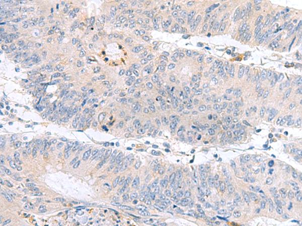 PDE6D / PDE6 Delta Antibody - Immunohistochemistry of paraffin-embedded Human colorectal cancer tissue  using PDE6D Polyclonal Antibody at dilution of 1:60(×200)