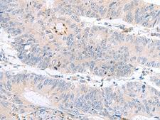 PDE6D / PDE6 Delta Antibody - Immunohistochemistry of paraffin-embedded Human colorectal cancer tissue  using PDE6D Polyclonal Antibody at dilution of 1:60(×200)
