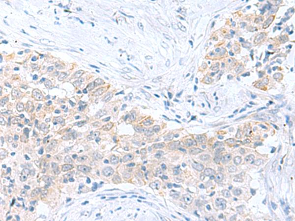 PDE6D / PDE6 Delta Antibody - Immunohistochemistry of paraffin-embedded Human esophagus cancer tissue  using PDE6D Polyclonal Antibody at dilution of 1:60(×200)