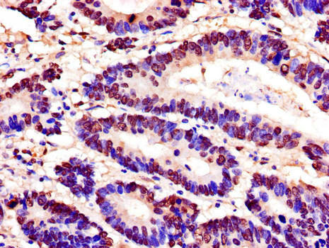 PDEF / SPDEF Antibody - Immunohistochemistry of paraffin-embedded human colon cancer using SPDEF Antibody at dilution of 1:100