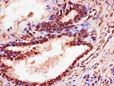 PDEF / SPDEF Antibody - Immunohistochemistry of paraffin-embedded human prostate cancer using SPDEF Antibody at dilution of 1:100
