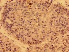 PDF / PLAB Antibody - Immunohistochemistry image of paraffin-embedded human liver cancer at a dilution of 1:100