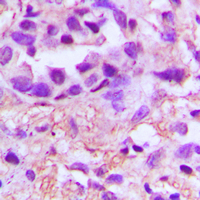 PDGF-AA Antibody - Immunohistochemical analysis of PDGFA staining in human lung cancer formalin fixed paraffin embedded tissue section. The section was pre-treated using heat mediated antigen retrieval with sodium citrate buffer (pH 6.0). The section was then incubated with the antibody at room temperature and detected using an HRP conjugated compact polymer system. DAB was used as the chromogen. The section was then counterstained with hematoxylin and mounted with DPX.