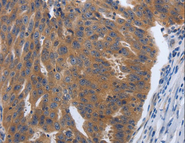 PDGF-AA Antibody - Immunohistochemistry of paraffin-embedded Human ovarian cancer using PDGFA Polyclonal Antibody at dilution of 1:70.