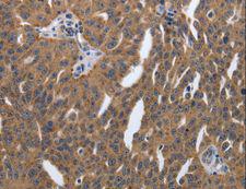 PDGF-AA Antibody - Immunohistochemistry of paraffin-embedded Human lung cancer using PDGFA Polyclonal Antibody at dilution of 1:40.