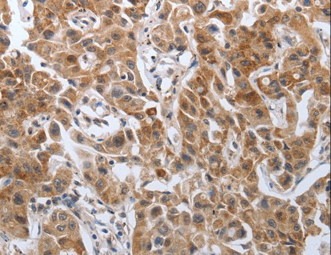 PDGF-AA Antibody - Immunohistochemistry of paraffin-embedded Human lung cancer using PDGFA Polyclonal Antibody at dilution of 1:40.