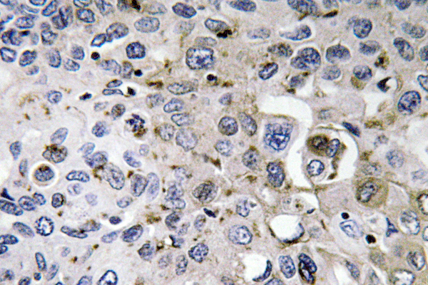 PDGF-AA Antibody - IHC of PDGF-A (K154) pAb in paraffin-embedded human lung carcinoma tissue.