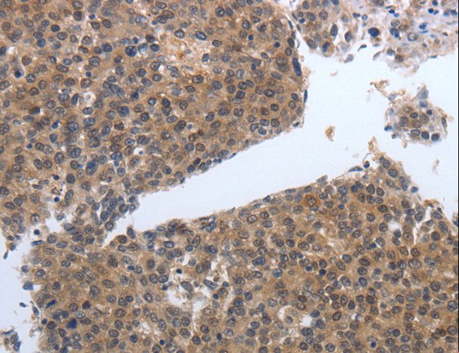 PDGF-BB Antibody - Immunohistochemistry of paraffin-embedded Human ovarian cancer using PDGFB Polyclonal Antibody at dilution of 1:40.