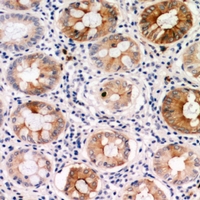 PDGF-CC Antibody - Immunohistochemical analysis of PDGFC staining in human colon cancer formalin fixed paraffin embedded tissue section. The section was pre-treated using heat mediated antigen retrieval with sodium citrate buffer (pH 6.0). The section was then incubated with the antibody at room temperature and detected using an HRP conjugated compact polymer system. DAB was used as the chromogen. The section was then counterstained with haematoxylin and mounted with DPX.