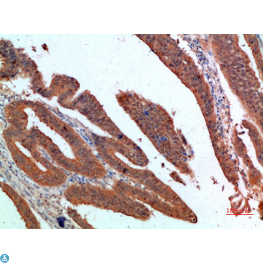 PDGF-CC Antibody - Immunohistochemical analysis of paraffin-embedded human-colon-cancer, antibody was diluted at 1:200.