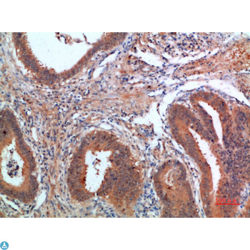 PDGF-CC Antibody - Immunohistochemical analysis of paraffin-embedded human-colon-cancer, antibody was diluted at 1:200.