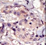 PDGFRA / PDGFR Alpha Antibody - Formalin-fixed and paraffin-embedded human cancer tissue reacted with the primary antibody, which was peroxidase-conjugated to the secondary antibody, followed by DAB staining. This data demonstrates the use of this antibody for immunohistochemistry; clinical relevance has not been evaluated. BC = breast carcinoma; HC = hepatocarcinoma.