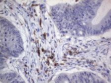 PDGFRA / PDGFR Alpha Antibody - IHC of paraffin-embedded Human colon tissue using anti-PDGFRA mouse monoclonal antibody. (Heat-induced epitope retrieval by 1 mM EDTA in 10mM Tris, pH8.5, 120°C for 3min).