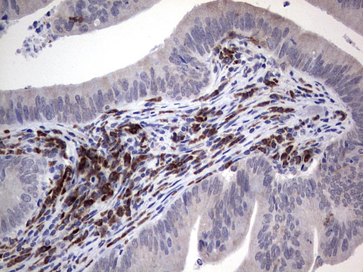 PDGFRA / PDGFR Alpha Antibody - IHC of paraffin-embedded Adenocarcinoma of Human colon tissue using anti-PDGFRA mouse monoclonal antibody. (Heat-induced epitope retrieval by 1 mM EDTA in 10mM Tris, pH8.5, 120°C for 3min).