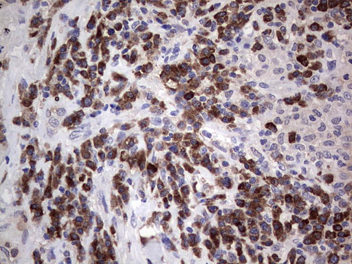 PDGFRA / PDGFR Alpha Antibody - IHC of paraffin-embedded Carcinoma of Human lung tissue using anti-PDGFRA mouse monoclonal antibody. (Heat-induced epitope retrieval by 1 mM EDTA in 10mM Tris, pH8.5, 120°C for 3min).