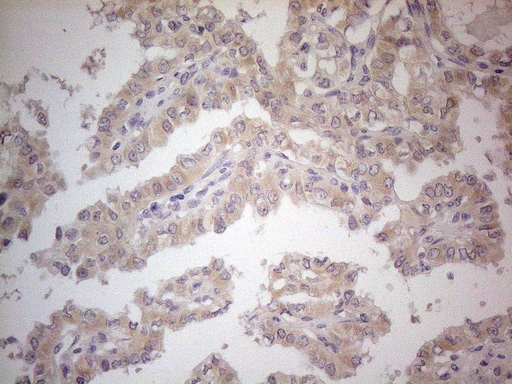 PDGFRA / PDGFR Alpha Antibody - Immunohistochemical staining of paraffin-embedded Carcinoma of Human thyroid tissue using anti-PDGFRA mouse monoclonal antibody. (Heat-induced epitope retrieval by 1mM EDTA in 10mM Tris buffer. (pH8.5) at 120°C for 3 min. (1:150)