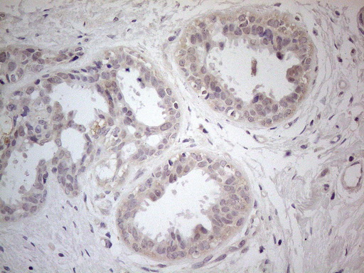 PDGFRA / PDGFR Alpha Antibody - Immunohistochemical staining of paraffin-embedded Adenocarcinoma of Human breast tissue using anti-PDGFRA mouse monoclonal antibody. (Heat-induced epitope retrieval by 1mM EDTA in 10mM Tris buffer. (pH8.5) at 120°C for 3 min. (1:150)
