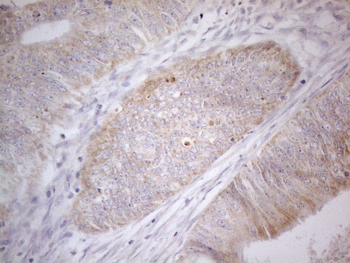 PDGFRA / PDGFR Alpha Antibody - Immunohistochemical staining of paraffin-embedded Adenocarcinoma of Human colon tissue using anti-PDGFRA mouse monoclonal antibody. (Heat-induced epitope retrieval by 1mM EDTA in 10mM Tris buffer. (pH8.5) at 120°C for 3 min. (1:150)
