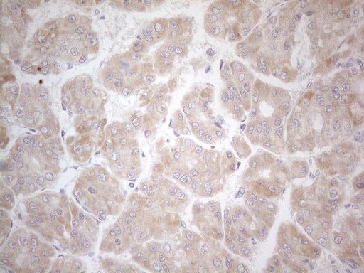 PDGFRA / PDGFR Alpha Antibody - Immunohistochemical staining of paraffin-embedded Carcinoma of Human liver tissue using anti-PDGFRA mouse monoclonal antibody. (Heat-induced epitope retrieval by 1mM EDTA in 10mM Tris buffer. (pH8.5) at 120°C for 3 min. (1:150)