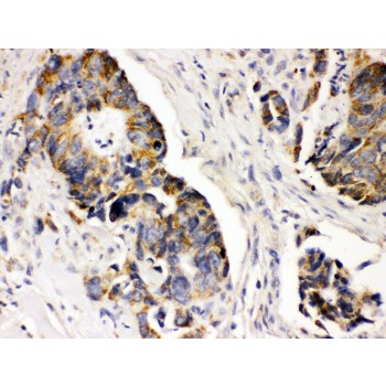 PDGFRA / PDGFR Alpha Antibody - PDGFRA antibody IHC-paraffin. IHC(P): Human Intestinal Cancer Tissue.