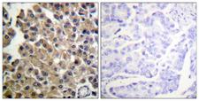 PDGFRB / PDGFR Beta Antibody - Immunohistochemistry analysis of paraffin-embedded human breast carcinoma tissue, using PDGFRB Antibody. The picture on the right is blocked with the synthesized peptide.