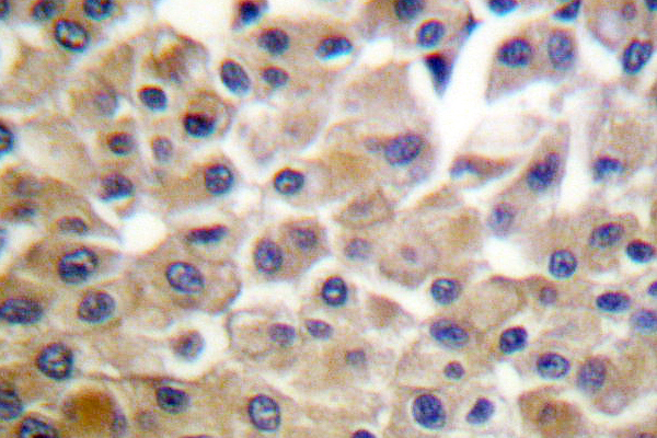 PDGFRB / PDGFR Beta Antibody - IHC of PDGFR- (D1003) pAb in paraffin-embedded human breast carcinoma tissue.