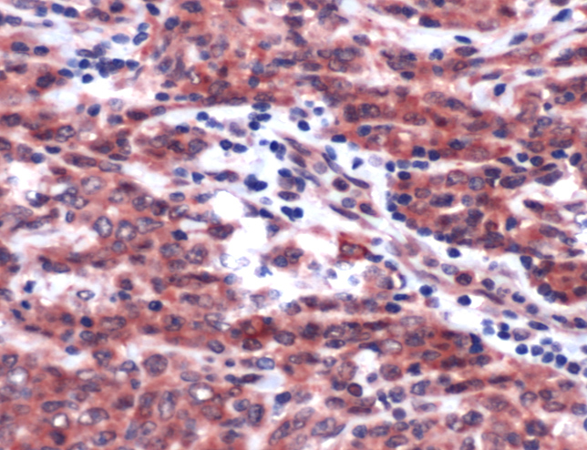 PDGFRB / PDGFR Beta Antibody - Immunohistochemistry of Human Ovarian Carcinoma stained with anti-PDGFR beta antibody