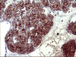 PDGFRB / PDGFR Beta Antibody - IHC of paraffin-embedded Carcinoma of Human thyroid tissue using anti-PDGFRB mouse monoclonal antibody. (Heat-induced epitope retrieval by 10mM citric buffer, pH6.0, 120°C for 3min).