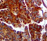 PDGFRB / PDGFR Beta Antibody - IHC of PDGFR-B on FFPE Ovarian Carcinoma tissue. This image was taken for the unmodified form of this product. Other forms have not been tested.