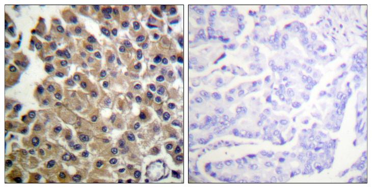 PDGFRB / PDGFR Beta Antibody - Peptide - + Immunohistochemistry analysis of paraffin-embedded human breast carcinoma tissue using PDGFR antibody.