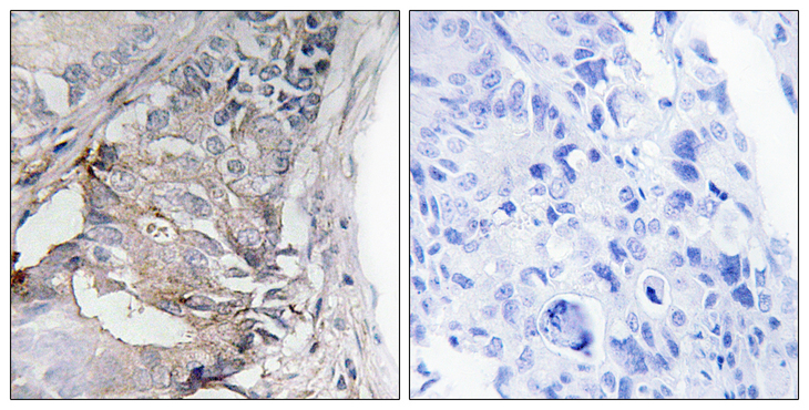 PDGFRB / PDGFR Beta Antibody - Immunohistochemistry analysis of paraffin-embedded human colon carcinoma, using PDGFR beta (Phospho-Tyr740) Antibody. The picture on the right is blocked with the phospho peptide.