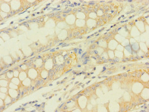 PDHA1 / PDH E1 Alpha Antibody - Immunohistochemistry of paraffin-embedded human colon cancer using PDHA1 Antibody at dilution of 1:100