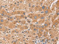 PDHA1 / PDH E1 Alpha Antibody - Immunohistochemistry of paraffin-embedded Human liver cancer tissue  using PDHA1 Polyclonal Antibody at dilution of 1:50(×200)