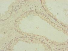 PDHA2 / PDH E1 Beta Antibody - Immunohistochemistry of paraffin-embedded human prostate cancer at dilution of 1:100