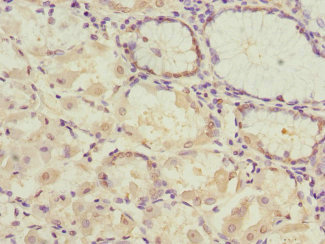 PDHB Antibody - Immunohistochemistry of paraffin-embedded human gastric cancer at dilution 1:100