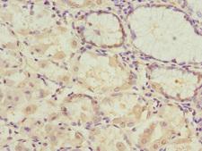 PDHB Antibody - Immunohistochemistry of paraffin-embedded human gastric cancer at dilution 1:100