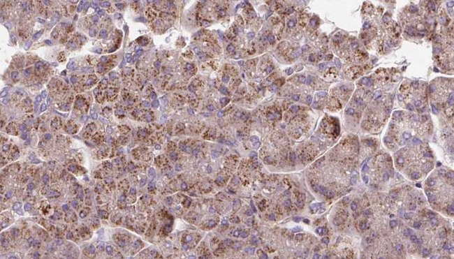 PDHX / Protein X / ProX Antibody - 1:100 staining human pancreas carcinoma tissue by IHC-P. The sample was formaldehyde fixed and a heat mediated antigen retrieval step in citrate buffer was performed. The sample was then blocked and incubated with the antibody for 1.5 hours at 22°C. An HRP conjugated goat anti-rabbit antibody was used as the secondary.