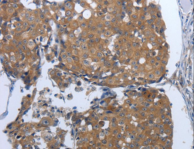 PDIA2 Antibody - Immunohistochemistry of paraffin-embedded Human liver cancer using PDIA2 Polyclonal Antibody at dilution of 1:50.