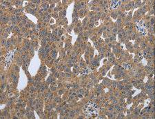 PDIA2 Antibody - Immunohistochemistry of paraffin-embedded Human lung cancer using PDIA2 Polyclonal Antibody at dilution of 1:50.