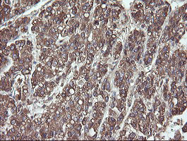 PDIA3 / ERp57 Antibody - IHC of paraffin-embedded Carcinoma of Human liver tissue using anti-PDIA3 mouse monoclonal antibody.